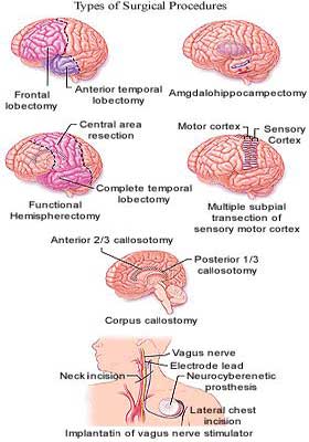 Medicine Acupuncture Herbal Treatment Cure Epilepsy Kuala Lumpur Herbs Medical Treatment Cure Centre